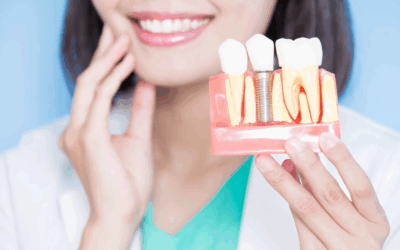 Implants dentaires : une solution fiable et durable pour retrouver votre sourire